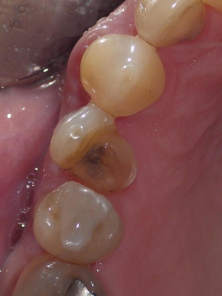 Fractured tooth | Dentist Duxbury MA