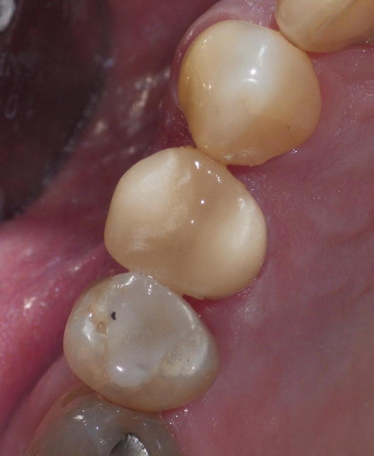Crown used to correct fractured tooth | Dentist Duxbury MA
