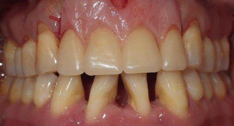 A-partial-denture-saves-a-smile-After-Image