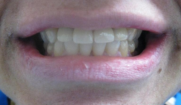 Dental implants and porcelain crowns to fix teeth | Dentist Duxbury MA