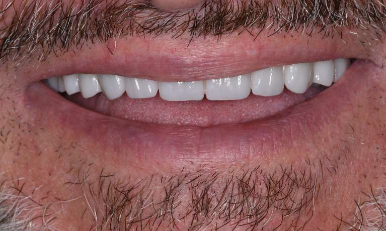 Amazing-Smile-Transformation-After-Image