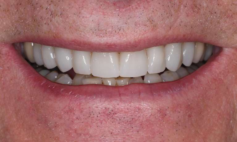 Instant-Smile-Transformation-with-Zirconia-Crowns-After-Image