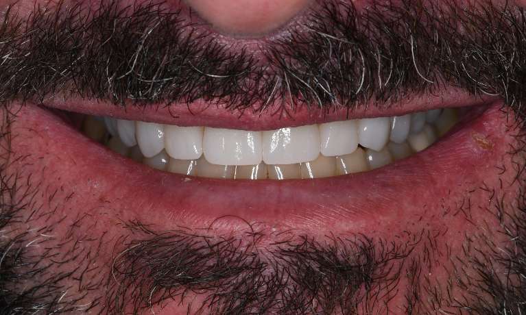 Restoring-a-Smile-with-Crowns-and-Dental-Implants-After-Image
