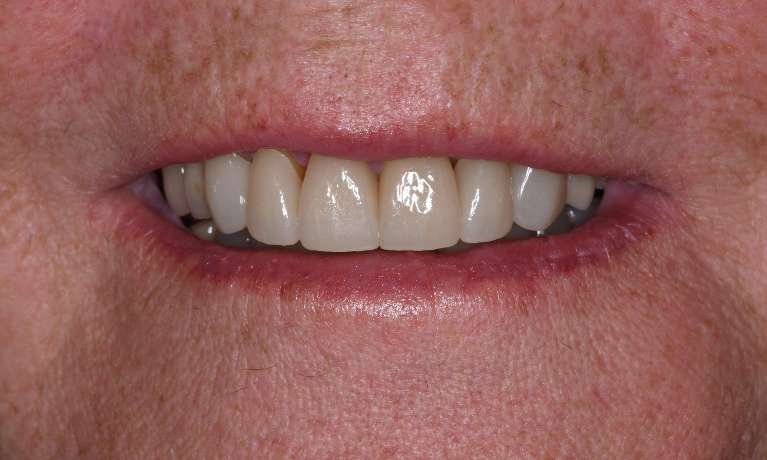 Six-Crowns-Make-Such-a-Difference-After-Image