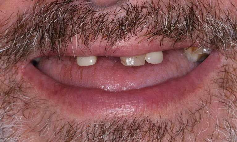 Amazing-Smile-Transformation-Before-Image