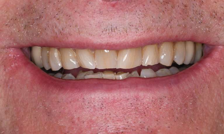 Instant-Smile-Transformation-with-Zirconia-Crowns-Before-Image