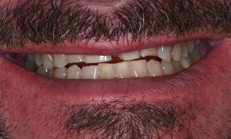 Restoring-a-Smile-with-Crowns-and-Dental-Implants-Before-Image