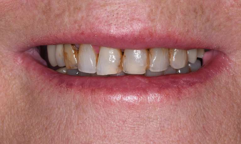Six-Crowns-Make-Such-a-Difference-Before-Image